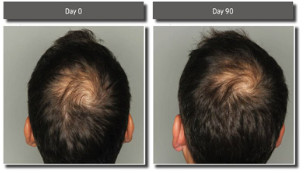 Viviscal hair supplement results