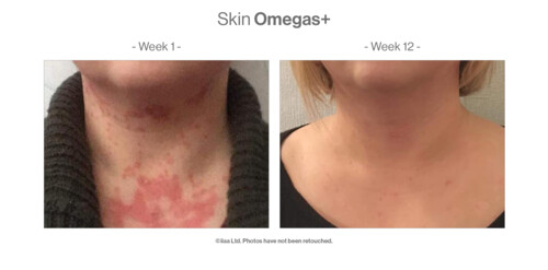 Advanced Nutrition Programme Case Study Results Skin Omegas IIAA sourced