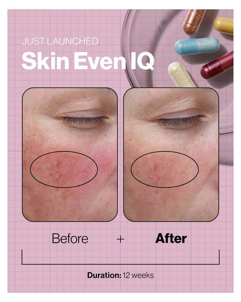 Skin Even IQ Before And After