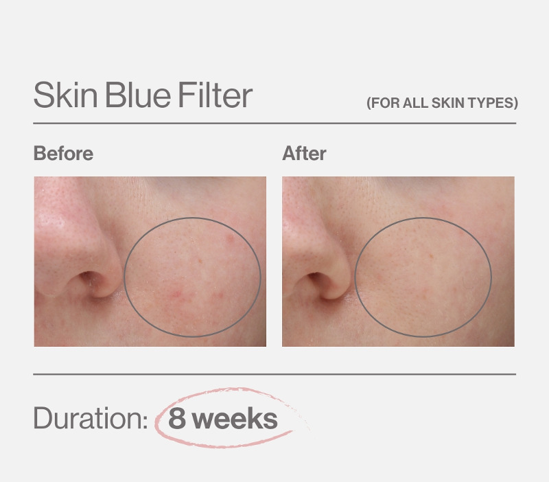 Skin Blue Filter Before after 800px